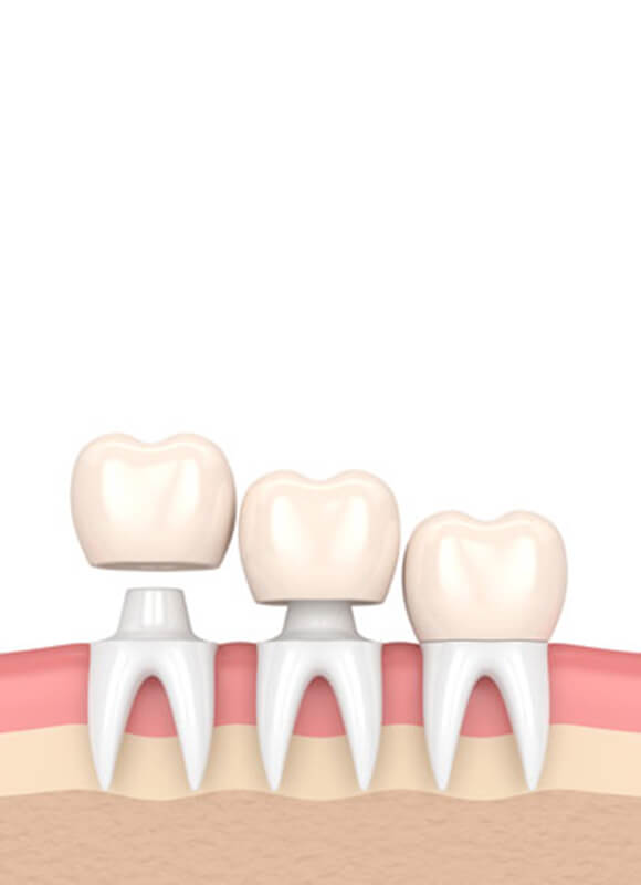 Dental caps - NewSmile Dental Perth