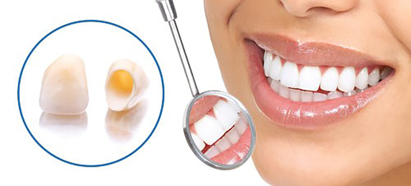 Dental caps - NewSmile Dental Perth