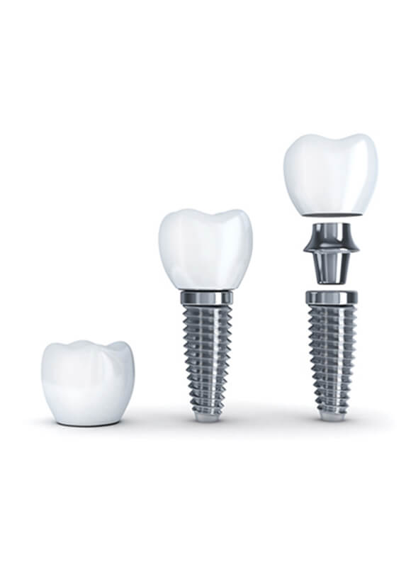 Dental implants - NewSmile Dental Perth