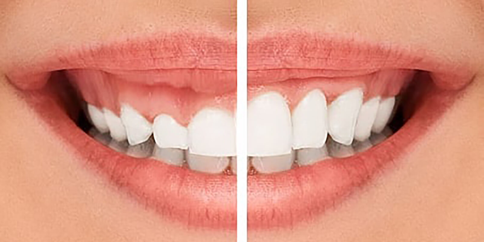 Gummy smile - NewSmile Dental Perth