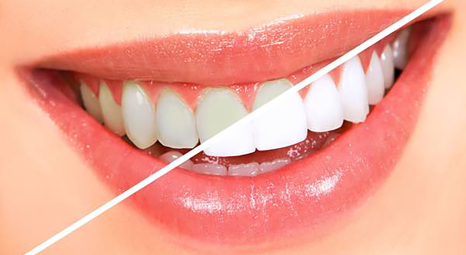 cheap teeth whitening treatments - NewSmile Dental Perth