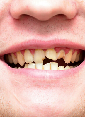 NewSmile Dental - Broken teeth