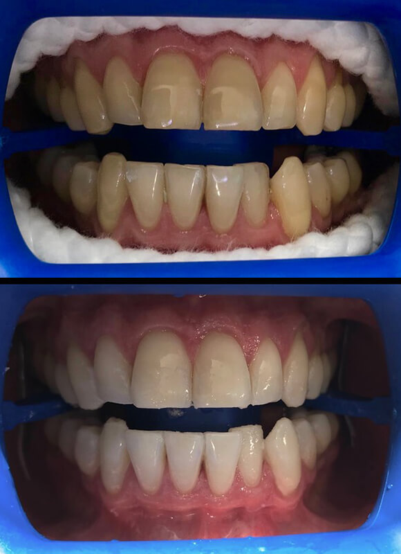 Stained teeth & teeth whitening- Teeth whitening NewSmile Dental Perth