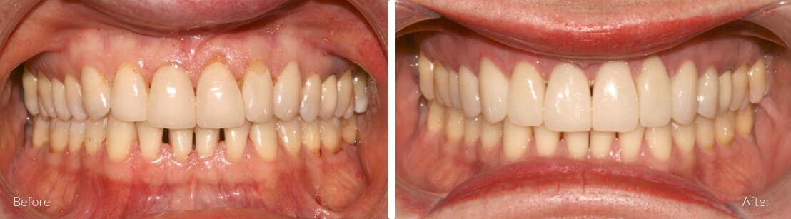 New Smile Dental Perth - Porcelain crowns & veneers