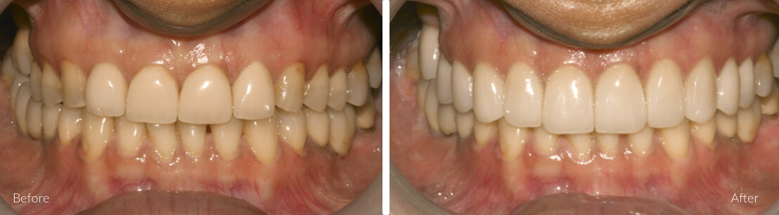 New Smile Dental Perth - Porcelain crowns & veneers