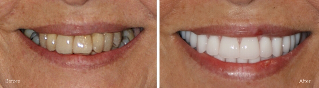 New Smile Dental Perth - Full mouth & full jaw implants