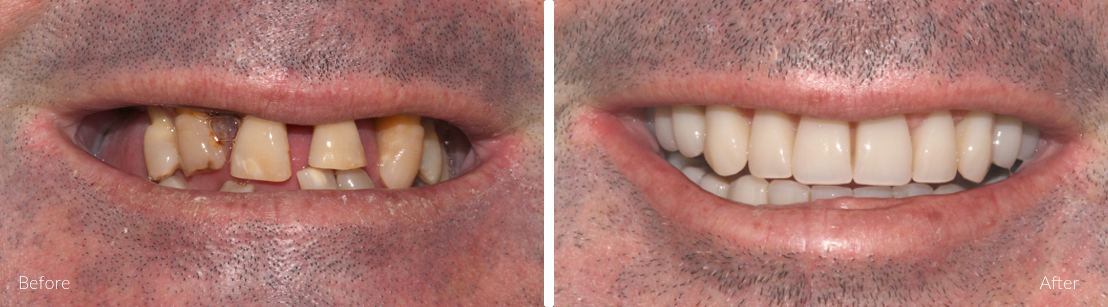 New Smile Dental Perth - Full mouth & full jaw implants