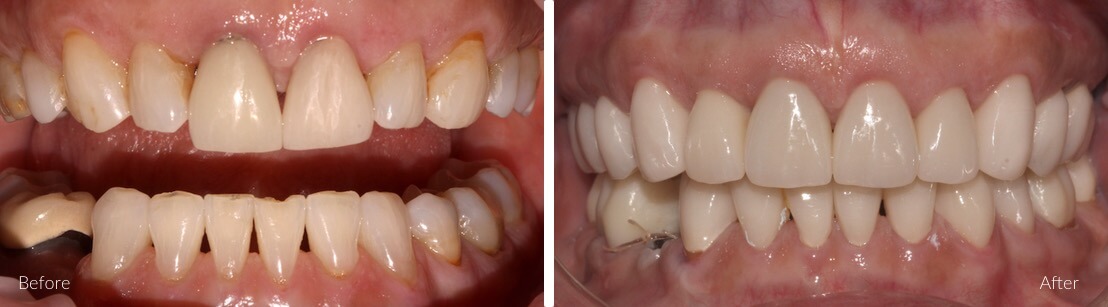New Smile Dental Perth - Rehabilitation of worn and broken down teeth