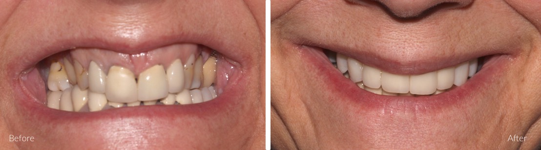 New Smile Dental Perth - Rehabilitation of worn and broken down teeth