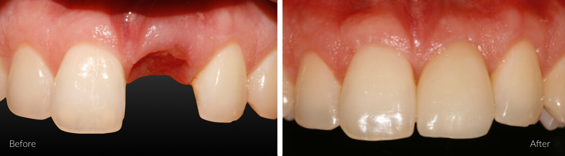 New Smile Dental Perth - Implants for single and multiple teeth