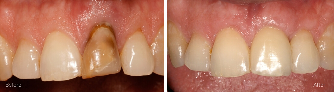 New Smile Dental Perth - Implants for single and multiple teeth