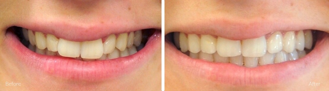 New Smile Dental Perth - Invisalign & orthodontics